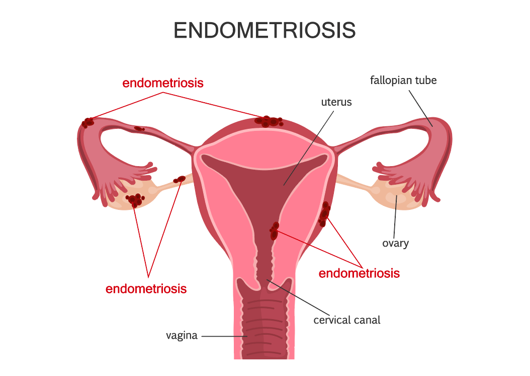 March Is Endometriosis Awareness Month Jacksonville Center For 6542